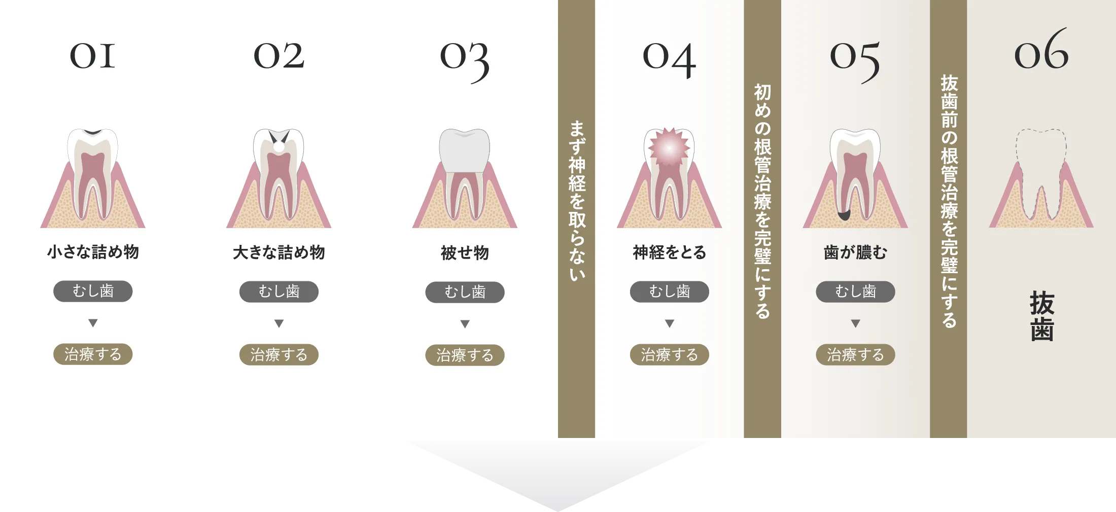 01:小さな詰め物 治療する、02:大きな詰め物 治療する、03:被せ物 治療する、04:神経をとる 治療する、05:歯が膿む治療する、06:抜歯
