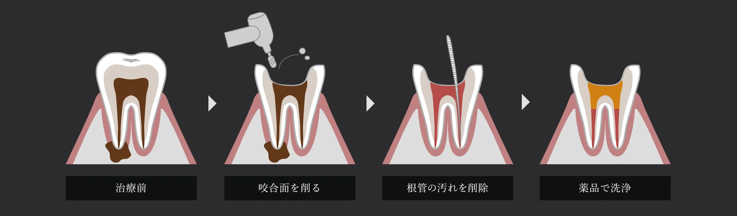 治療前→咬合面を削る→根管の汚れを削除→薬品で洗浄