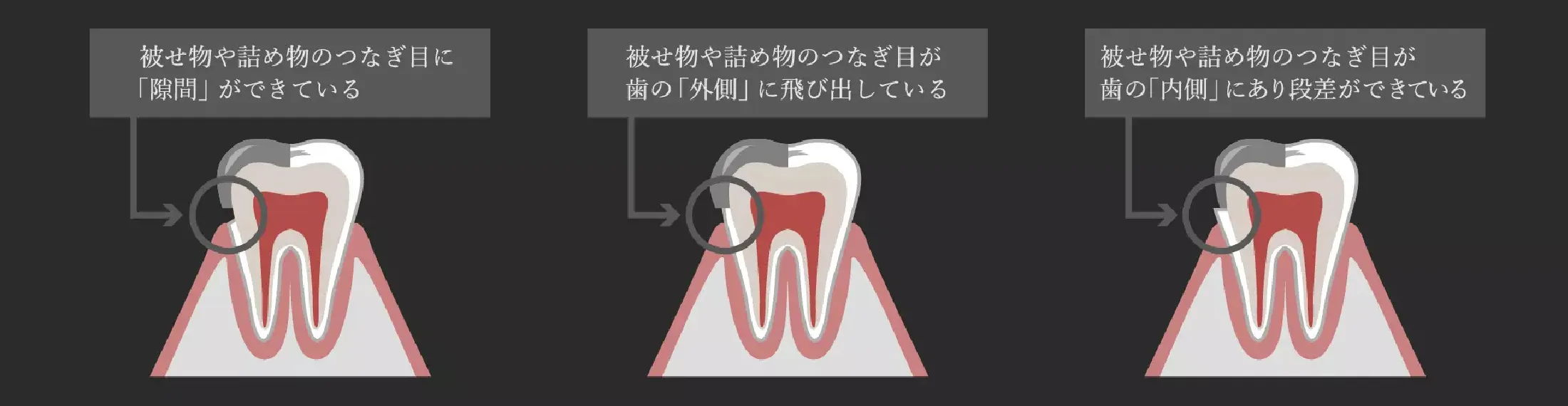 被せ物や詰め物のつなぎ目に「隙間」ができる、被せ物や詰め物のつなぎ目が歯の「外側」に飛び出している、被せ物や詰め物のつなぎ目が歯の「内側」にあり段差ができている