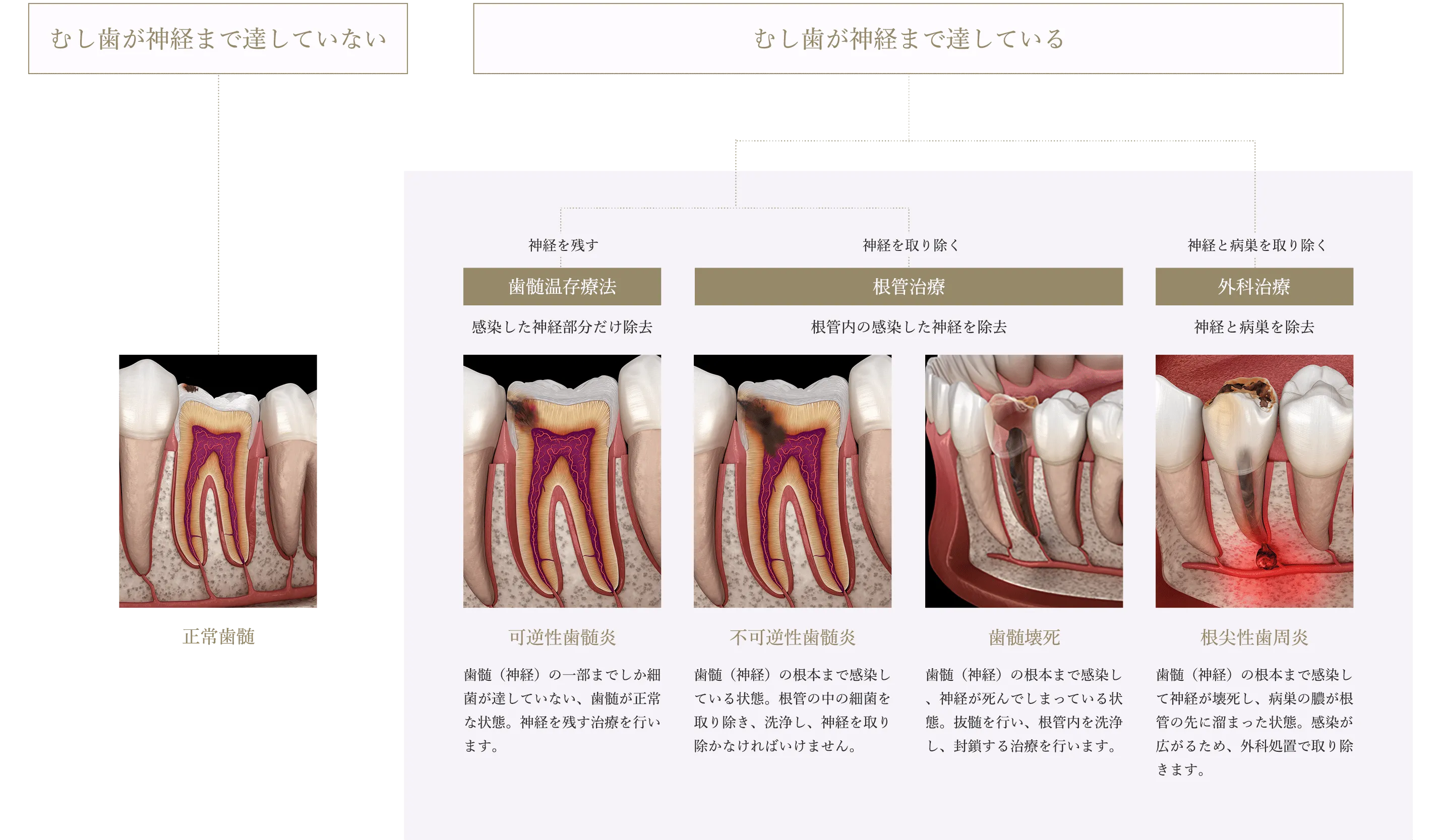 神経の感染状態でみる「歯を残すための」治療のフローチャート