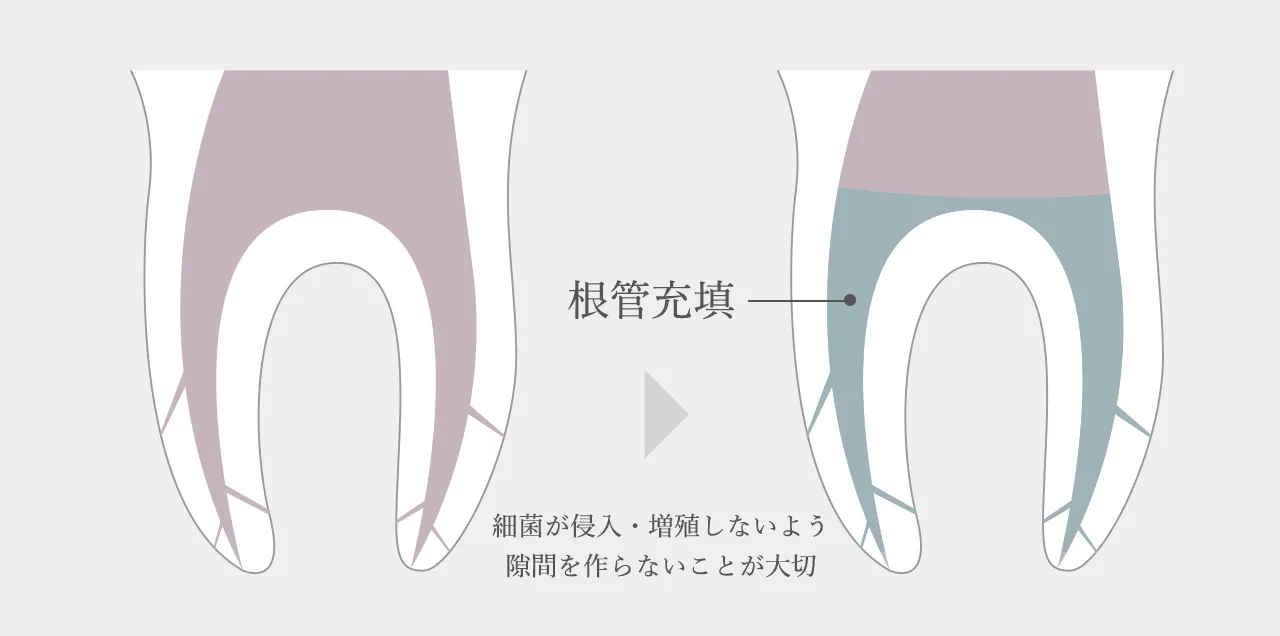 細菌が侵入・増殖を防ぐため、MTAセメントで封鎖し、神経と血管を残す。