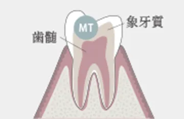 間接覆髄法（IPC）