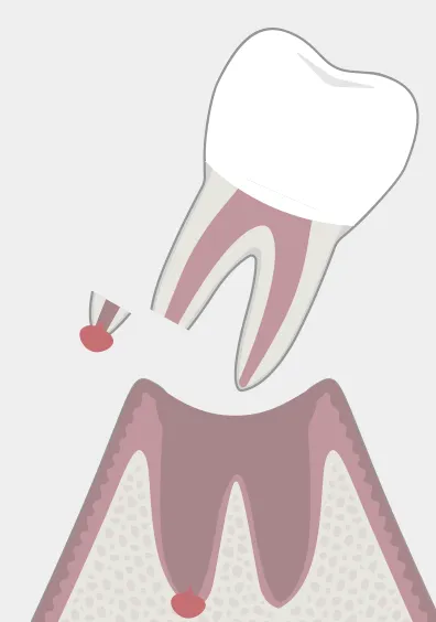抜歯して病変を切除