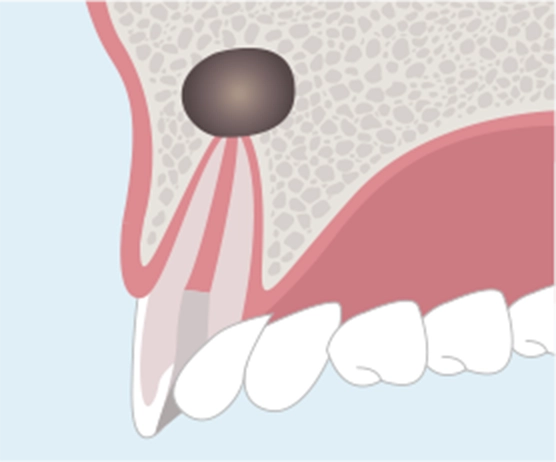 歯の根の先に膿がたまった状態。