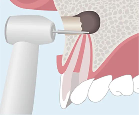 歯茎側から病巣を切除する。