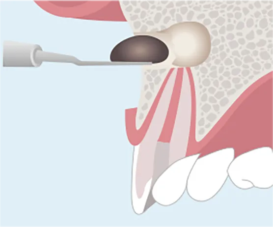 病巣を切除し、MTAセメント（殺菌する薬剤）を詰める。