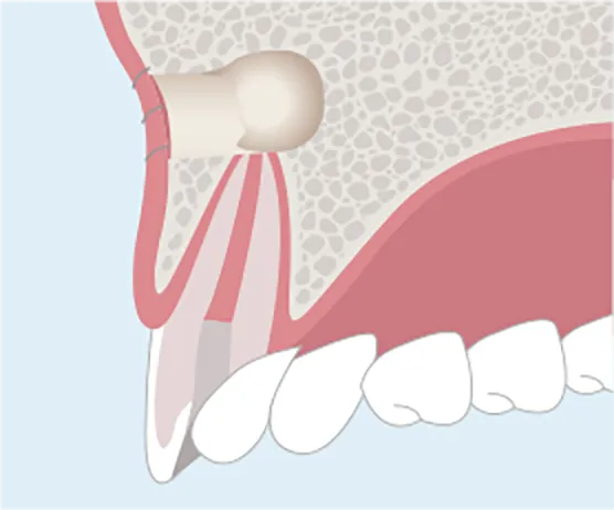 縫合する。治療後、骨は自然に再生します。