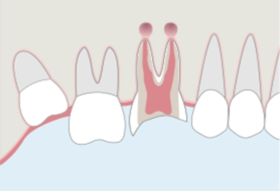 歯の保存不可の状態。