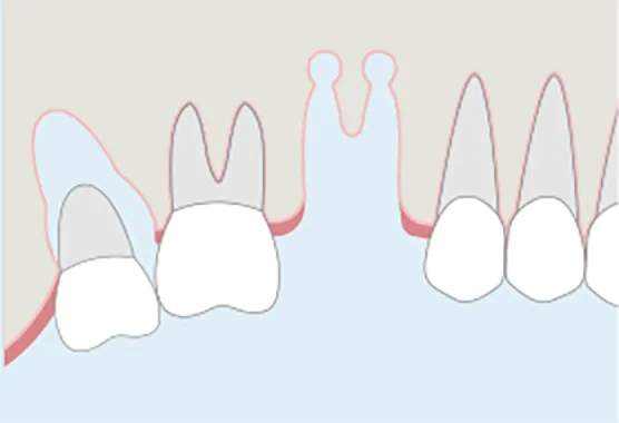 保存不可の歯を抜歯し、ドナー歯を抜歯する。