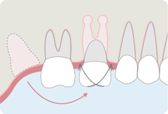 抜歯したドナー歯を移植・固定する。