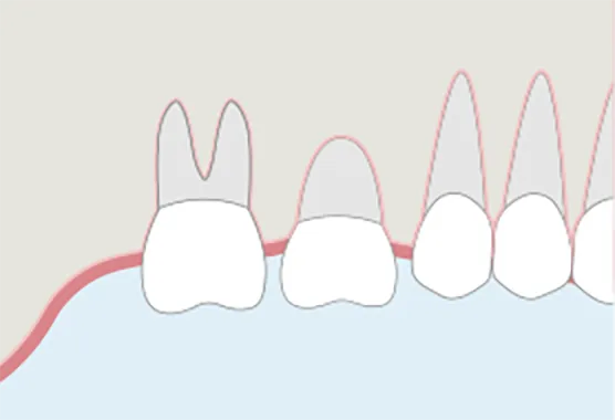 移植した歯が定着するのを待つ。
