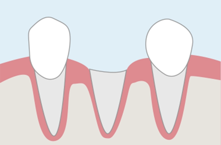 歯肉に歯が埋れてしまっている状態。
