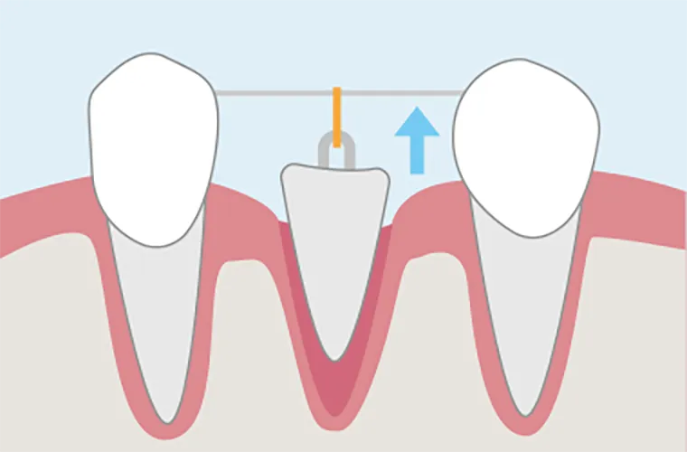 残った歯に矯正器具をつけて、ゆっくりと上に引っ張り上げます。