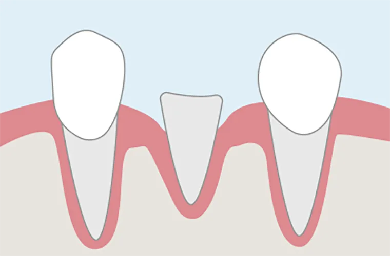 引っ張り出した部分に被せ物の土台が確保できるようになります。