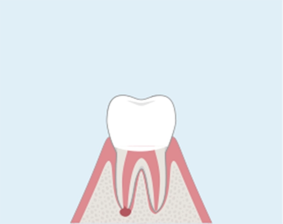 歯の根の先に膿がたまった状態。
