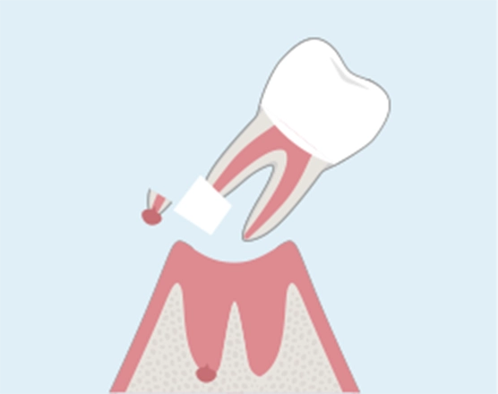 抜歯して、直接歯の病巣を切除します。