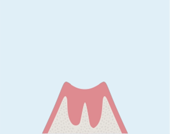 病巣部分を除去し、洗浄・殺菌します。