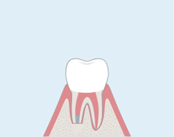 歯を元の位置に戻し、歯が固定されるのを待ちます。