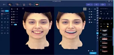 インプラントシミュレーション。埋入位置の正確に行う3Dデジタル画像