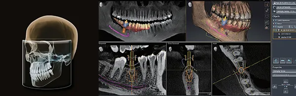 安全性と正確性の低被ばくのX線CT画像診断力