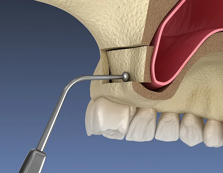 ラテラルウィンドウアプローチ