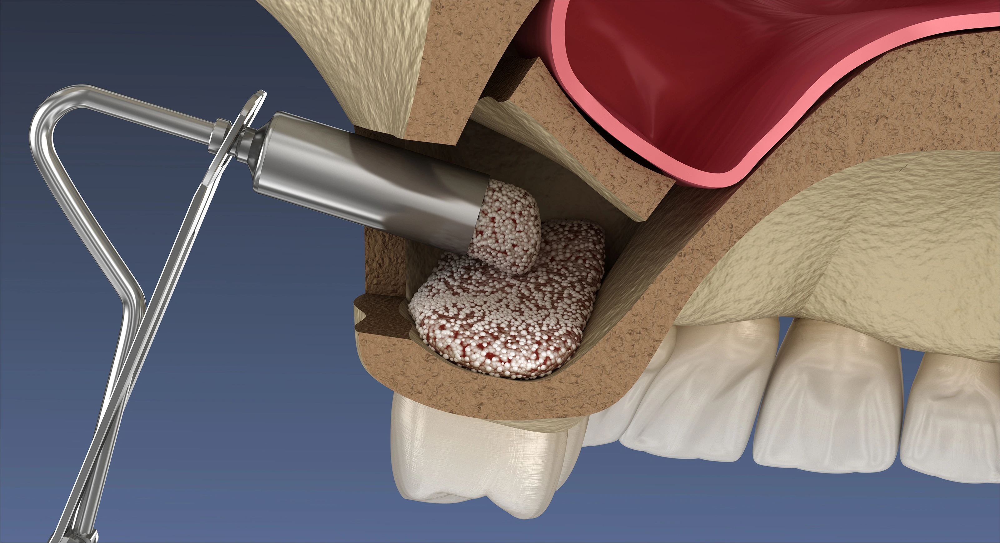 サイナスリフトについて