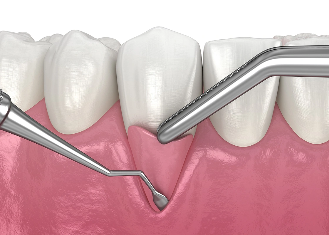 骨造成と合わせて行う結合組織移植（CTG）