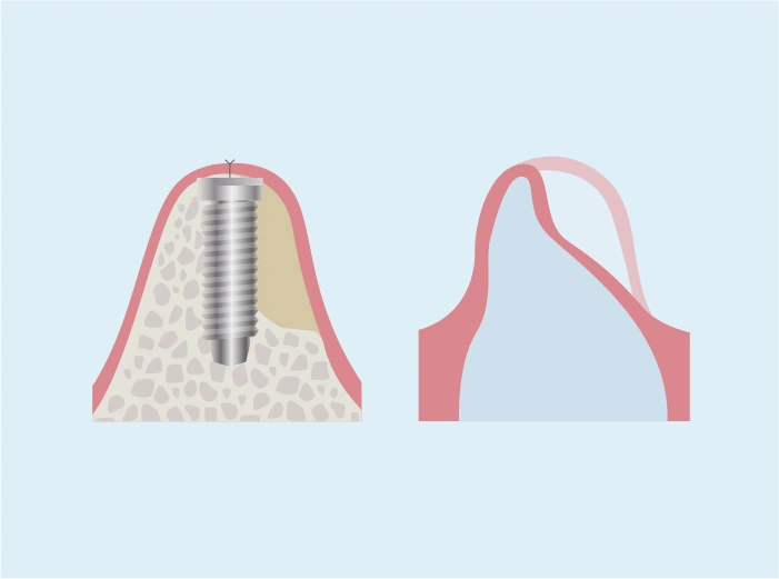 吸収性メンブレン使用したGBR（軽度）