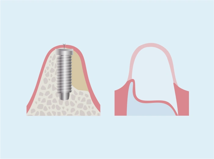 吸収性メンブレン使用したGBR（高度）