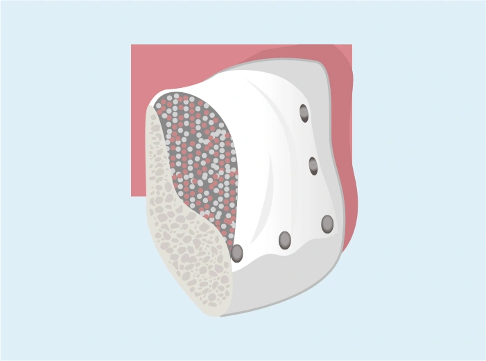 ソーセージテクニックGBR（高度）