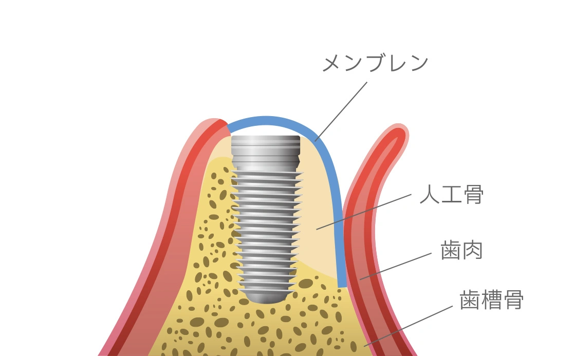 インプラントのための骨再生誘導法（GBR）