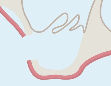 上顎洞粘膜の剥離