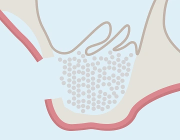 人工骨を入れる