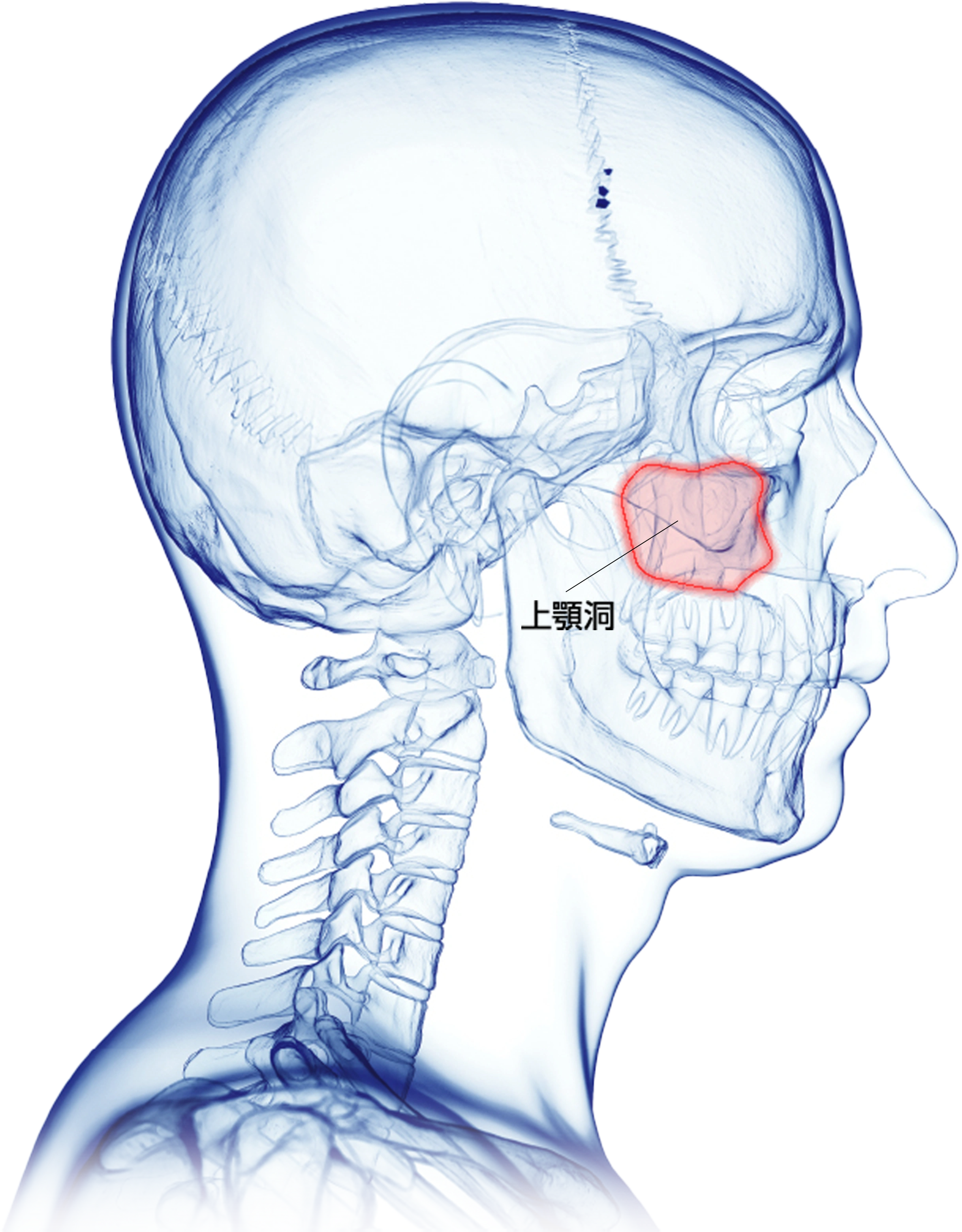 上顎の骨造成もインプラントが可能