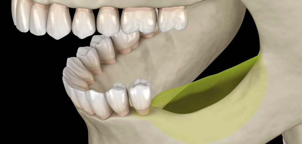 骨造成について