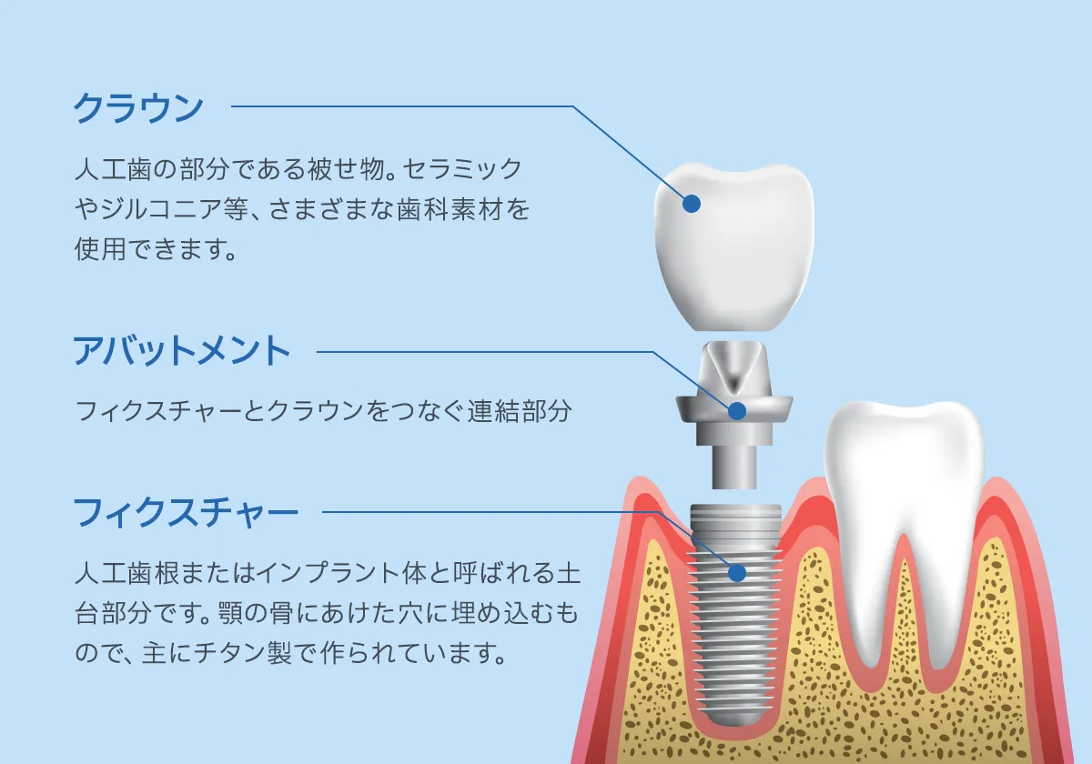 クラウン、アパットメント、フィクスチャー