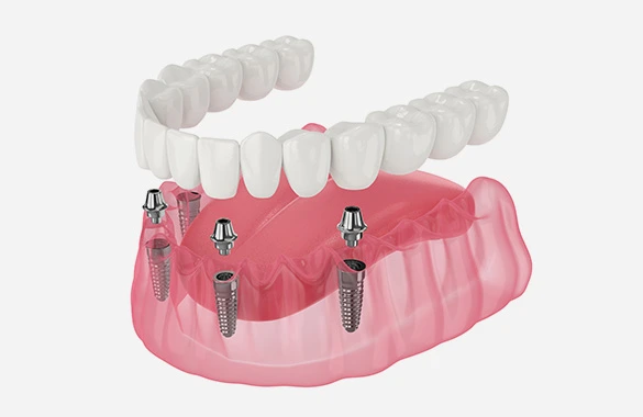 インプラントの本数を減らしたい