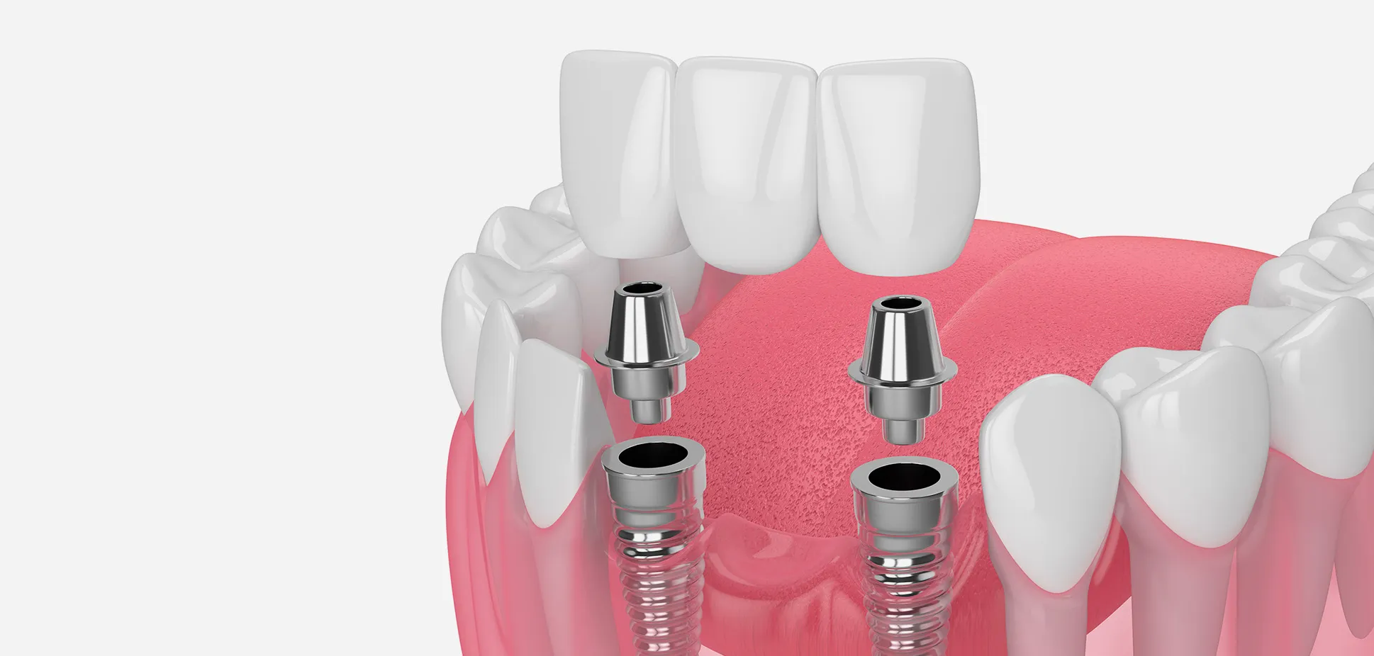 前歯がなくなることを気にしている方へ