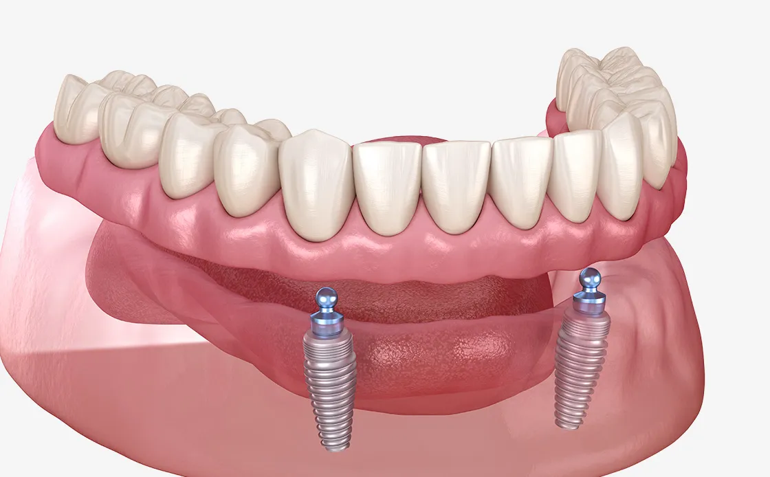 オーバーデンチャー