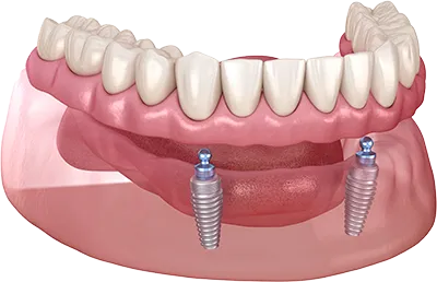 オーバーデンチャー