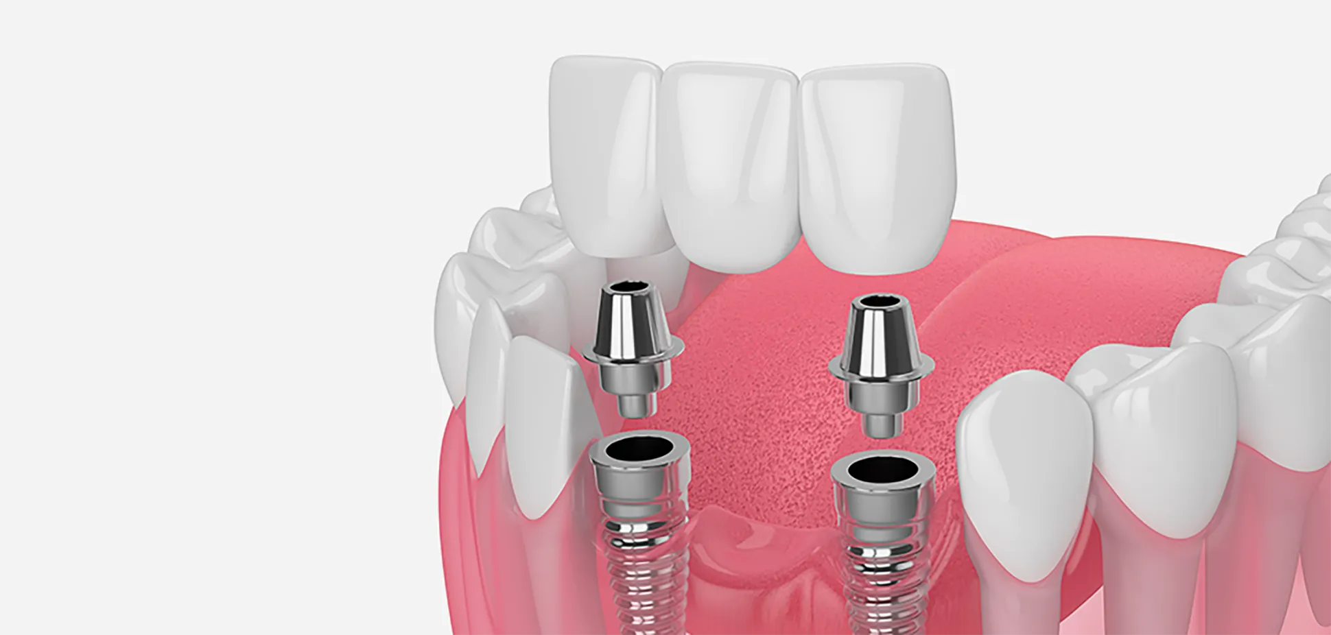 インプラントの本数を減らしたい方へ
