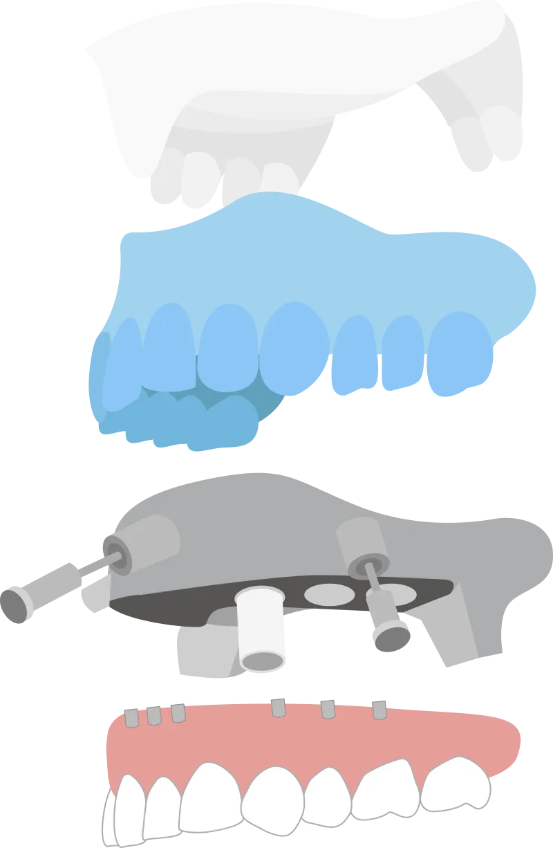 サージカルガイドの役割