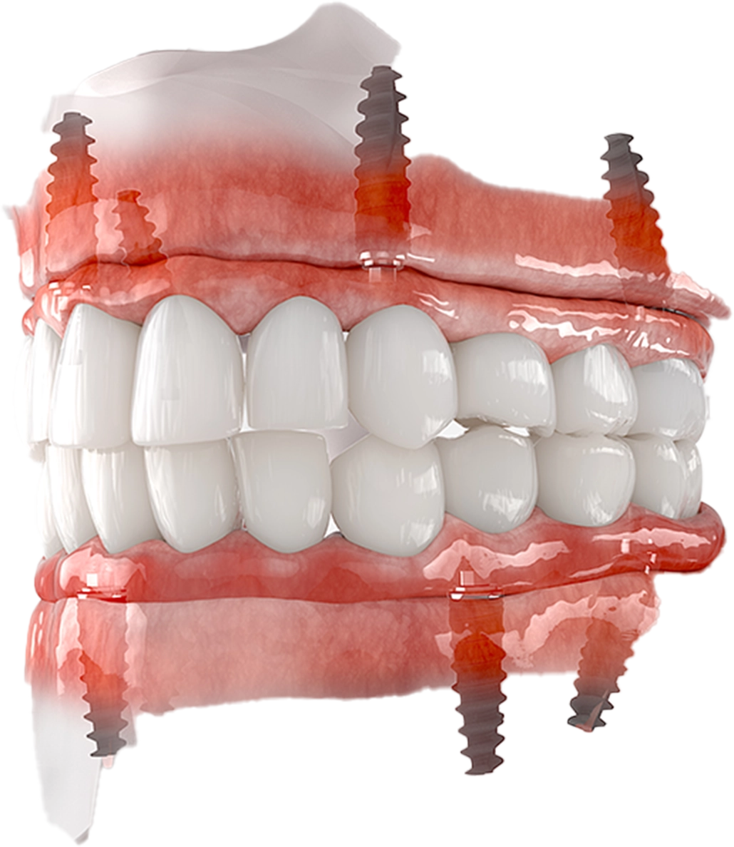 埋入ポジションを設計