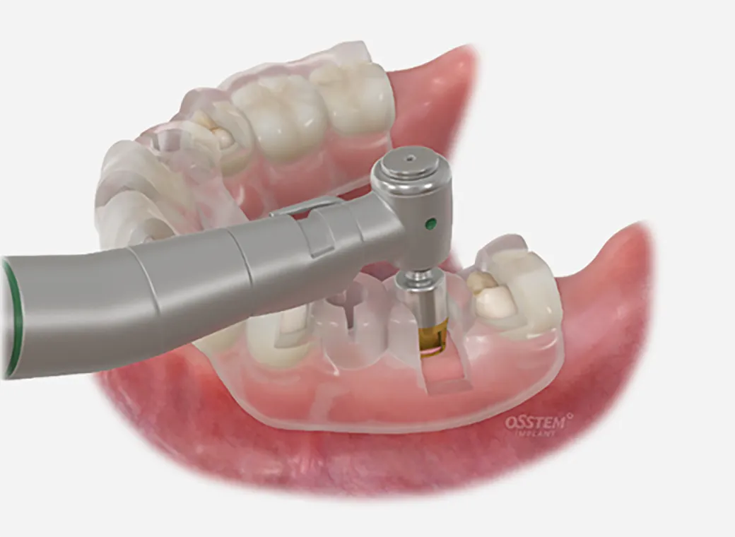 構造力学的に最良の位置に埋入できる