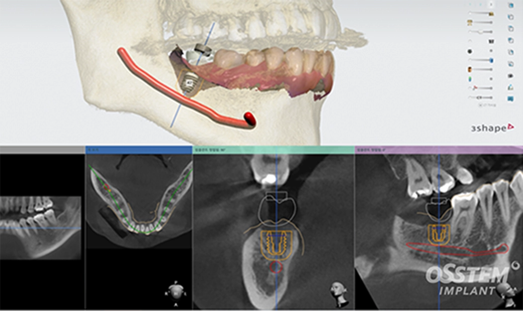手術時間が短く負担が軽減する
