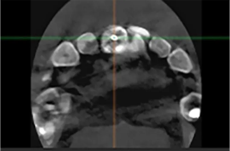 検査（CT・口腔内スキャン）