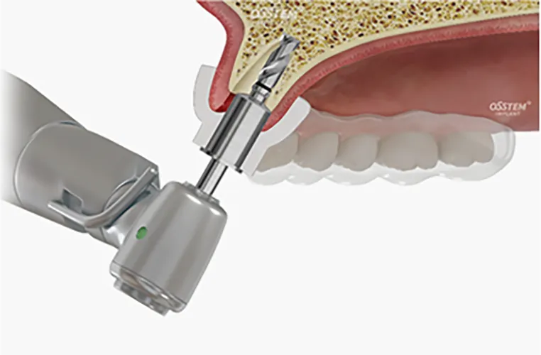 インプラント埋入