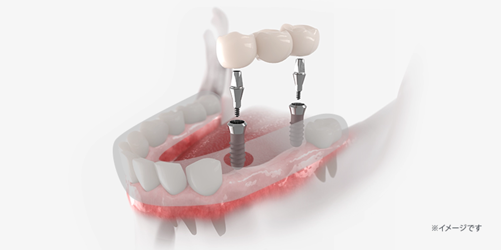 サージカルガイド