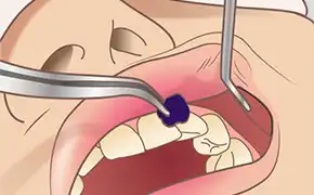 口腔清掃状態チェック