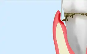 歯周ポケット掻爬